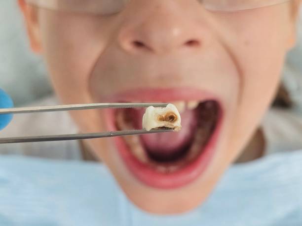 Best Cracked Tooth Emergency Dentist  in White Oak, TX